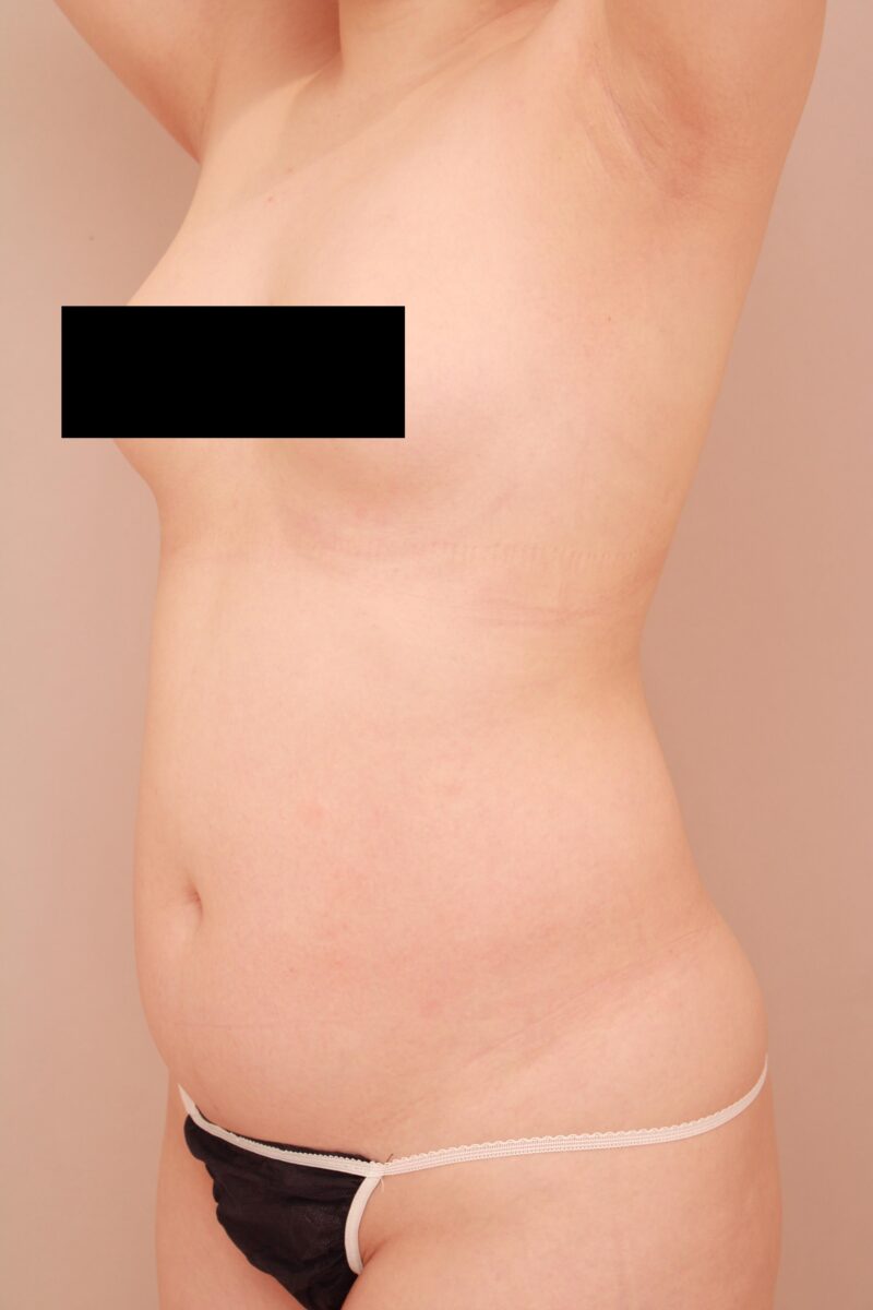 ベイザー脂肪吸引（6か月経過：28）の術前写真