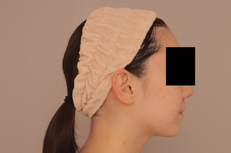 ベイザー脂肪吸引(3か月経過:20)の術前写真