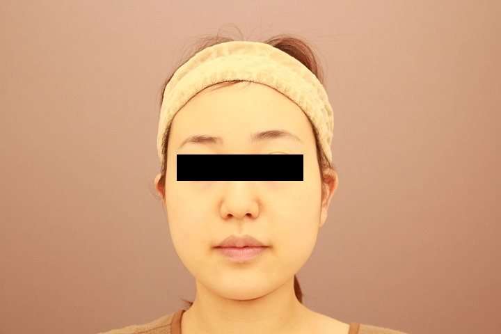 顔の脂肪吸引 たるむことはありません