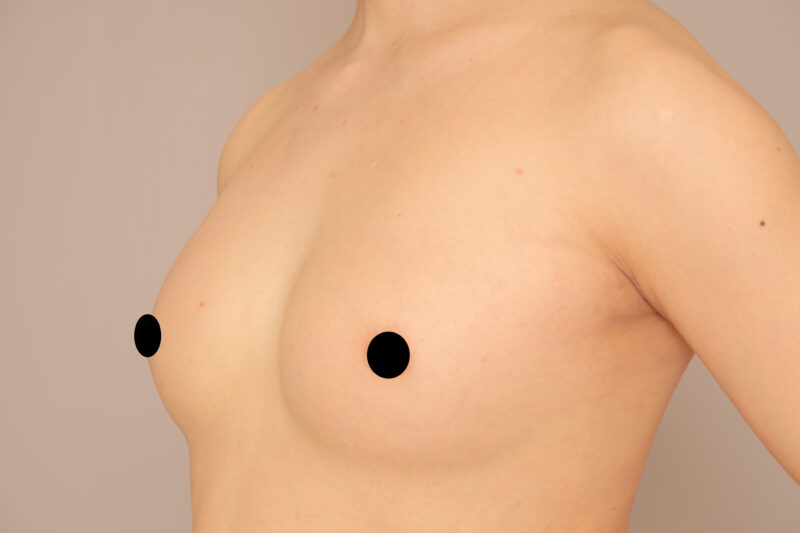 元男性(性転換なしホルモン治療なし)の方の豊胸のモニター様10ヶ月後
