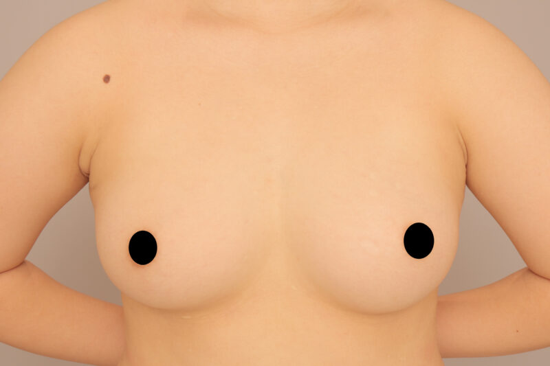 三角ゾーンを強化♫21歳授乳経験無しのモニター様コンデンスリッチ豊胸3か月後