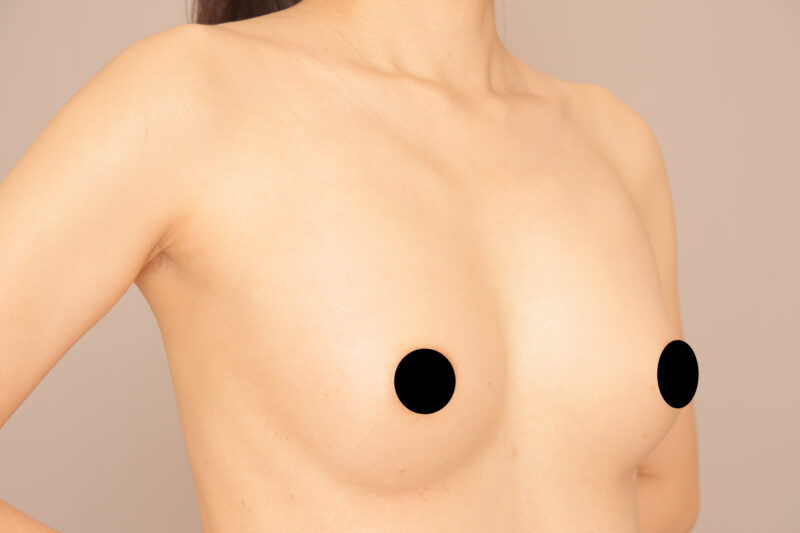 痩せ型40代授乳経験無しのモニター様コンデンスリッチ豊胸3か月後♡