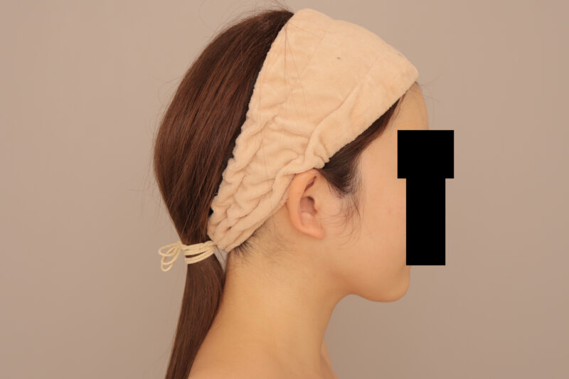 フェイスラインをシュッとさせて垢抜けよう!20代モニター様半年後