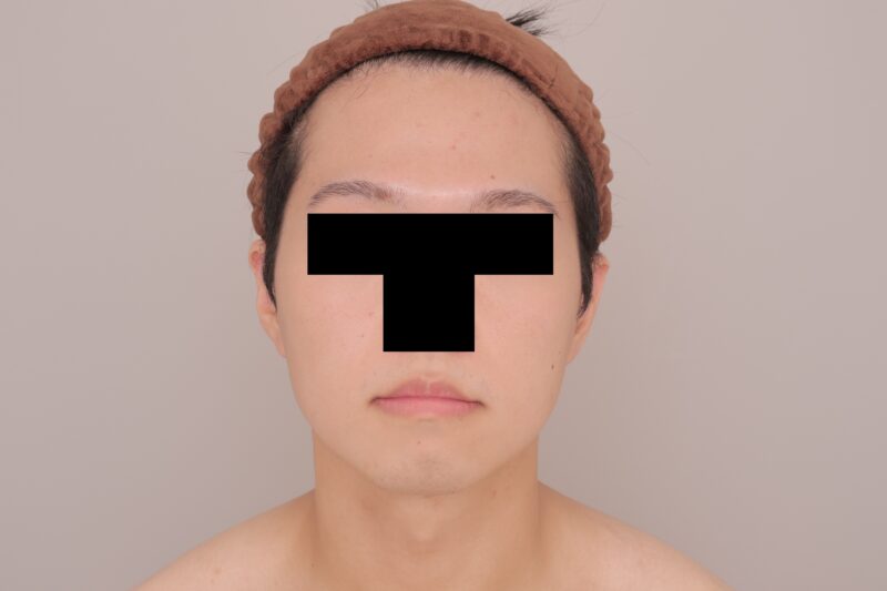 【男性】頬＋顎下+BTX １か月経過～25歳, 177cm, 73kg～