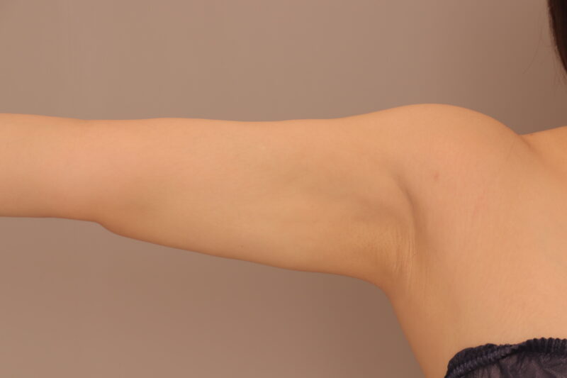 二の腕全周のモニター様3か月後♫劇的変化!!