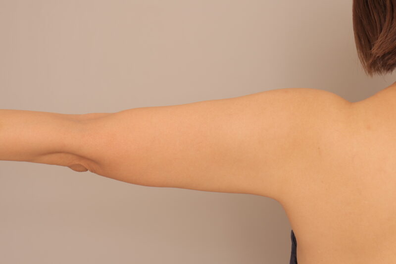 50代のモニター様二の腕肩の脂肪吸引3か月後♡二の腕のシルエットを変えよう!!