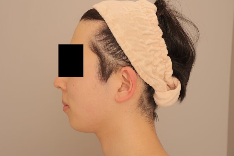 ベイザー脂肪吸引（6か月経過：27）の術前写真