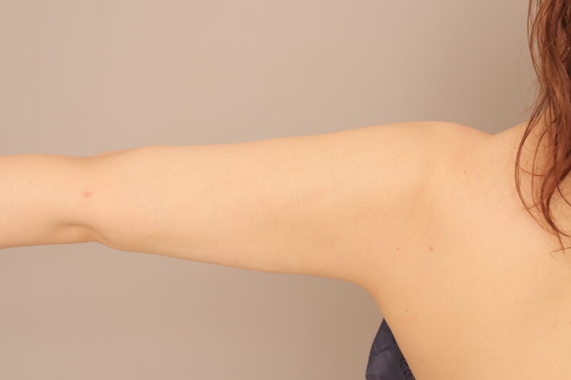 二の腕全周の脂肪吸引モニター様3か月後♡