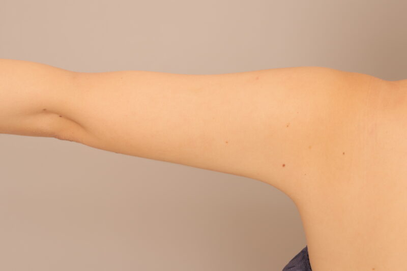 二の腕肩の脂肪吸引半年後♡スラッと華奢な二の腕に♡