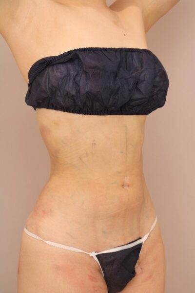 お腹の脂肪吸引 翌日の状態