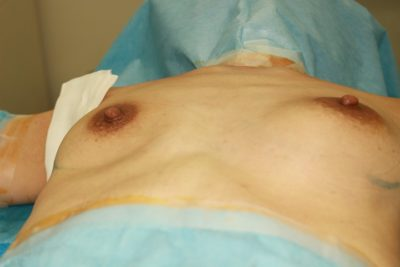 生理食塩水バック抜去&コンデンスリッチ豊胸 1か月経過