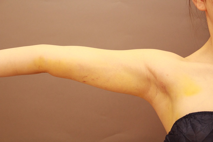 二の腕の脂肪吸引 1週間後の内出血の様子