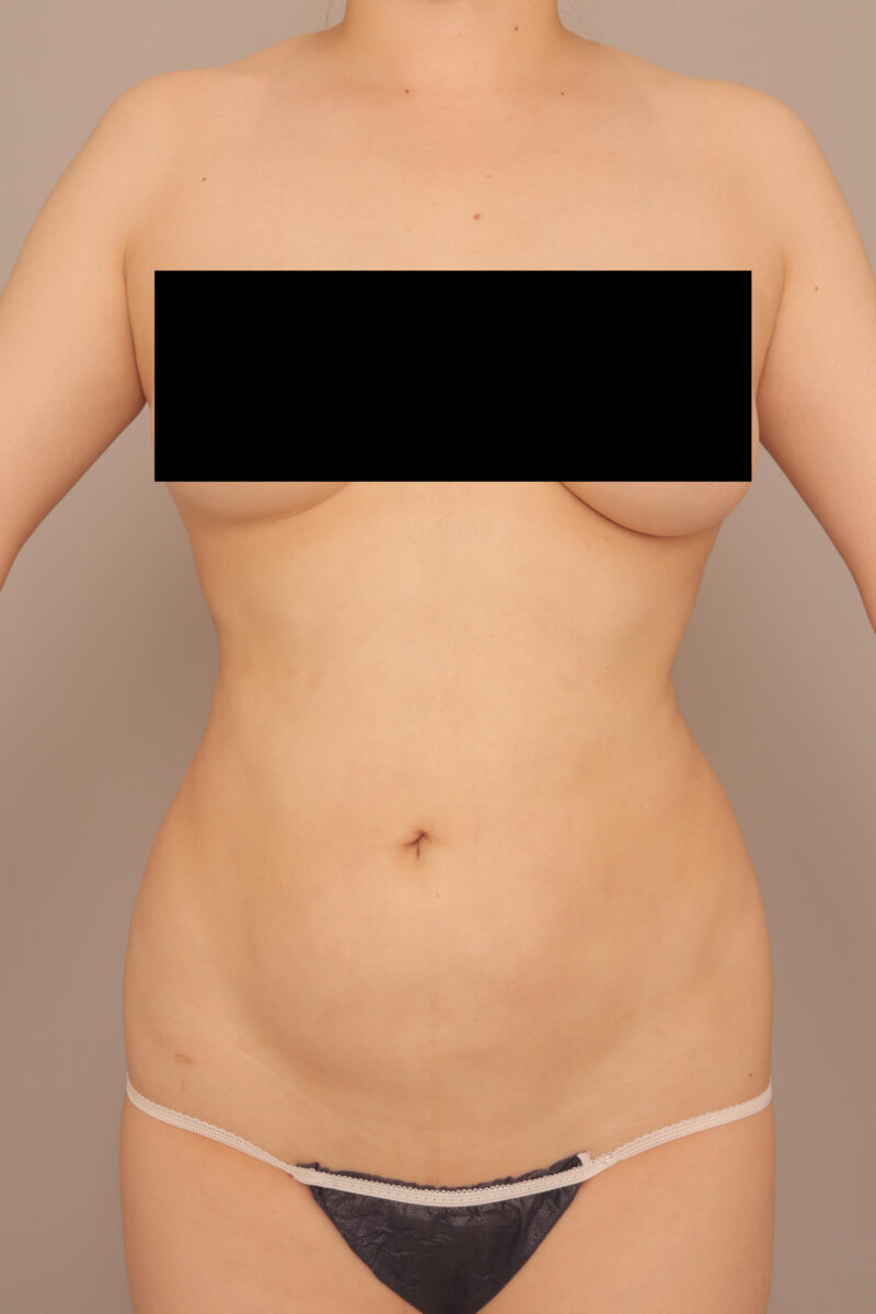 みんなで目指そう峰不二子♡お腹全体胸下腰の脂肪吸引3か月後