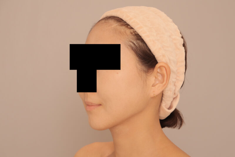 頬顎脂肪吸引でフェイスライン激変♡40代モニター様3か月後