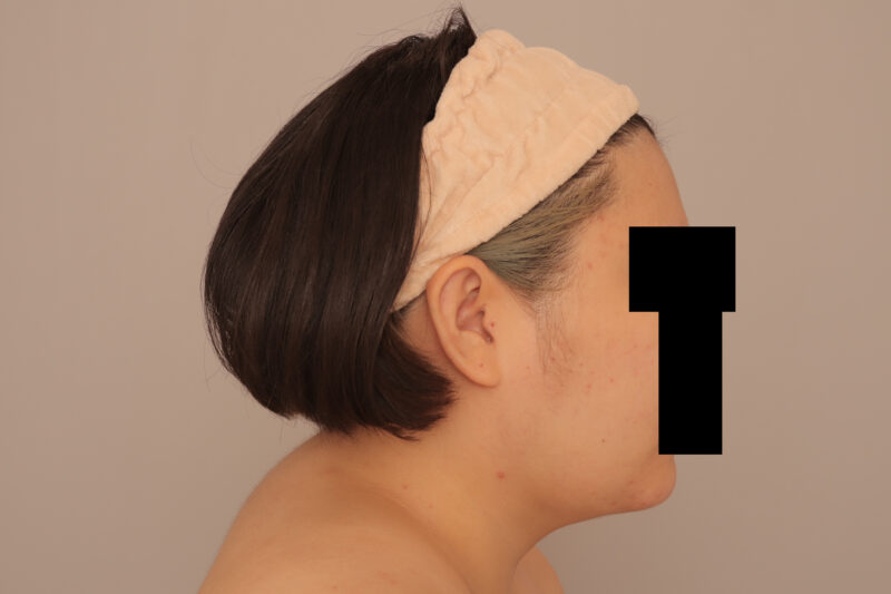 嬉しいくて人生で初めてショートカットに♡頬顎脂肪吸引のモニター様1ヶ月後