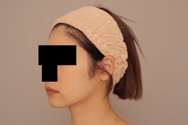 頬顎脂肪吸引のモニター様3か月後♫