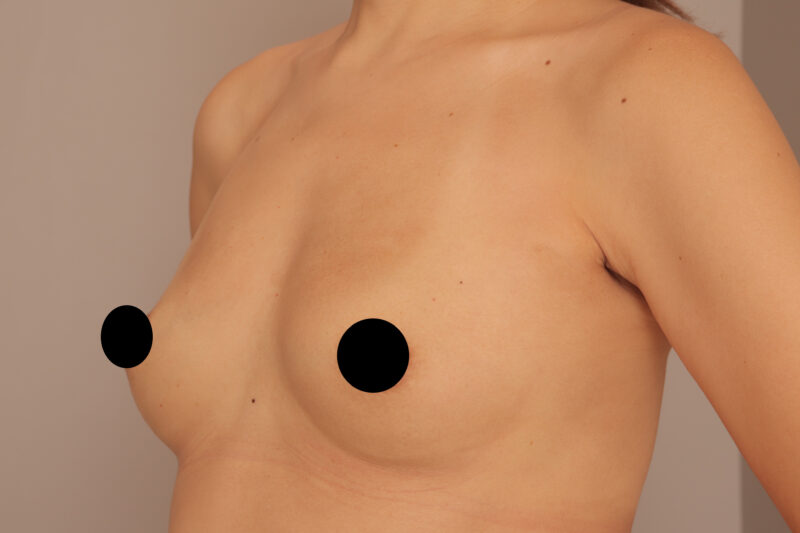 シリコンバッグを抜去して&コンデンスリッチ豊胸で自然なバストに♫6ヶ月後