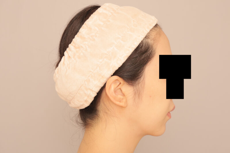 頬顎脂肪吸引で逆卵型の輪郭に♡フェイスラインすっきり!!