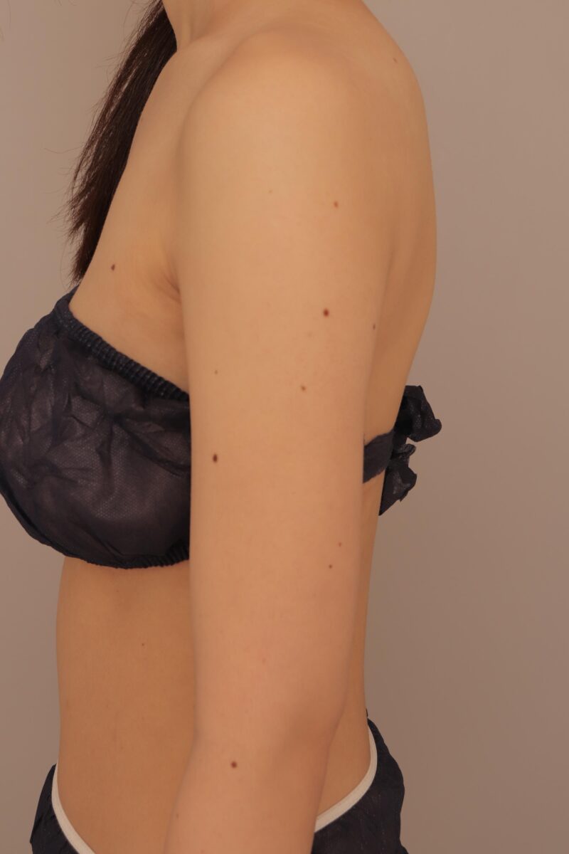 二の腕、肩、脇肉の脂肪吸引のモニター様3か月後♡