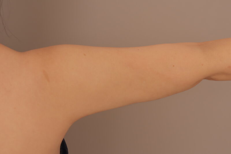昨日のモニター様の二の腕脇肉の変化
