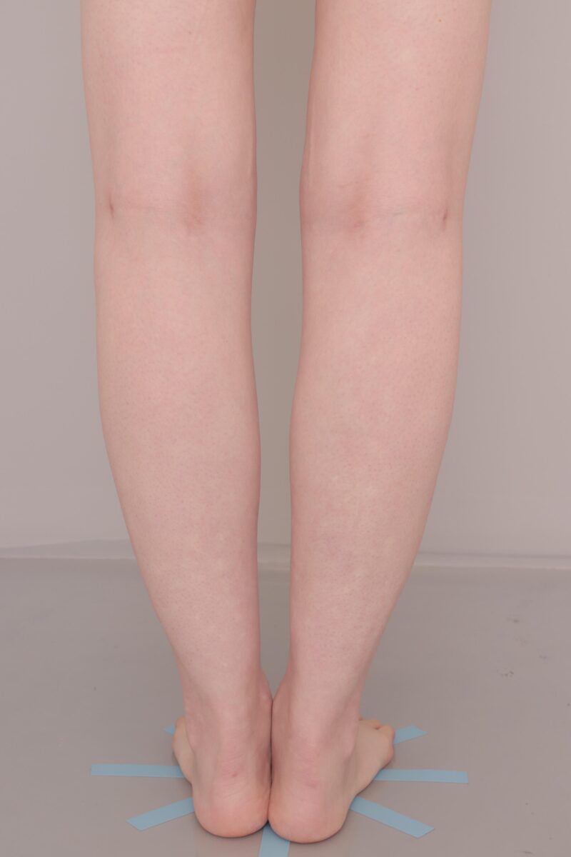 ベイザー脂肪吸引（半年後経過：25）の術後写真