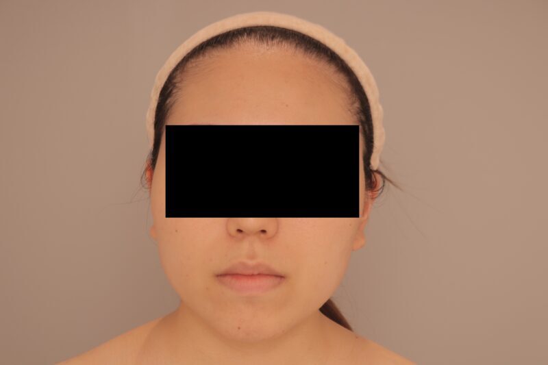 ベイザー脂肪吸引(3か月経過:24)の術前写真