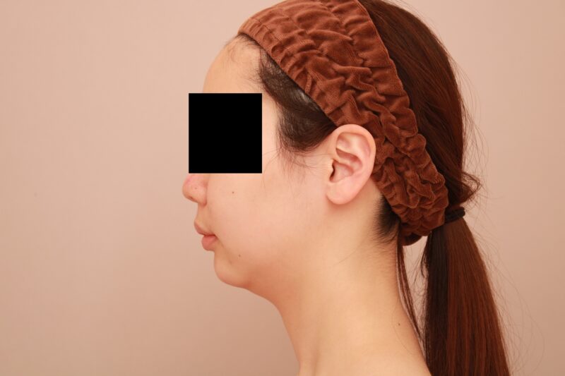 ベイザー脂肪吸引(6か月経過:24)の術前写真