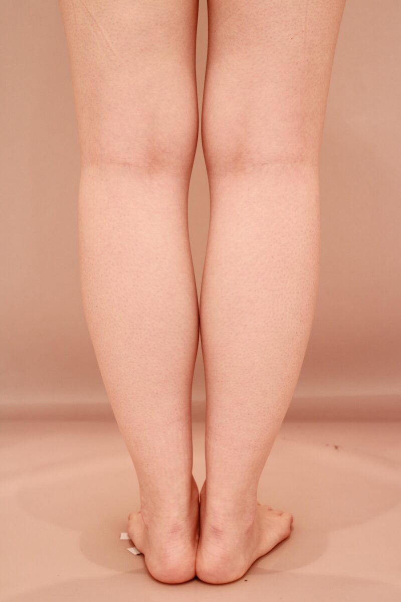 ベイザー脂肪吸引（半年後経過：25）の術前写真