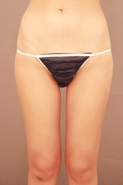 太ももの脂肪吸引 まとめ