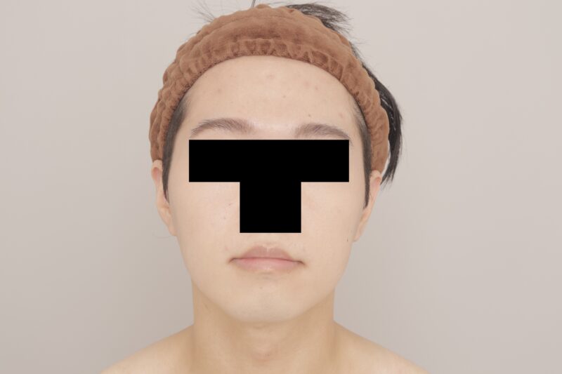 【男性】頬＋顎下+BTX ３か月経過～25歳, 177cm, 73kg～