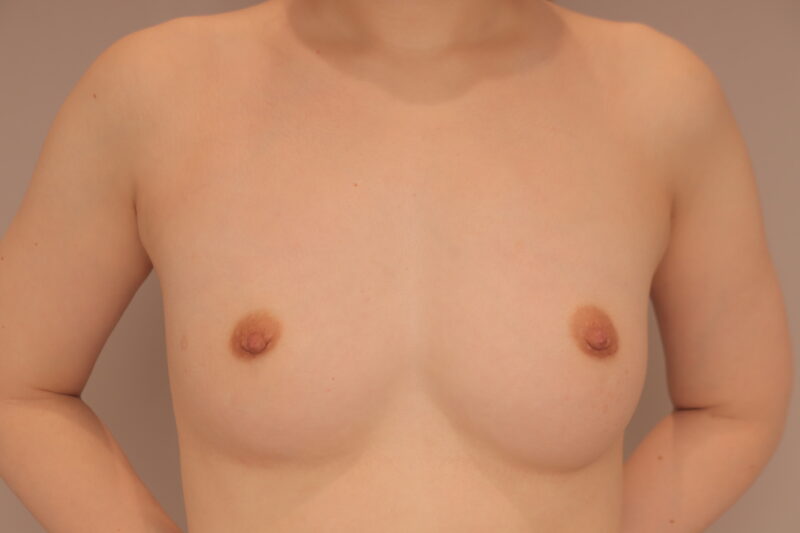 彼氏も大興奮♪コンデンスリッチ豊胸でますます美ボディに♡3か月後