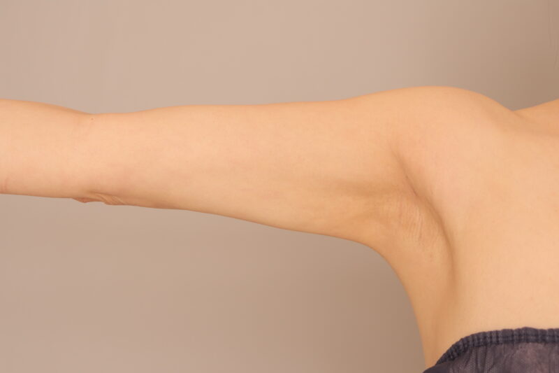 「バスト注入していないのにバスト大きくなった?」脇肉、二の腕肩の脂肪吸引で50代のモニター様のボディラインを変化♡