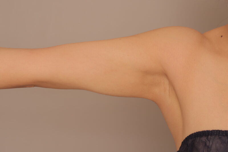二の腕、肩の脂肪でコンデンスリッチ豊胸したモニター様3か月後♪二の腕編