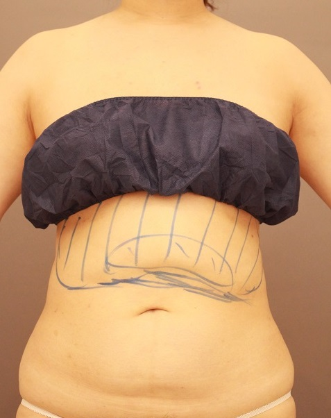 お腹の他院修正