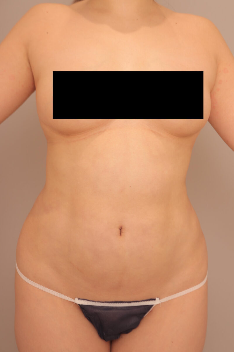 みんなで目指そう峰不二子♡お腹全体胸下腰の脂肪吸引3か月後♪