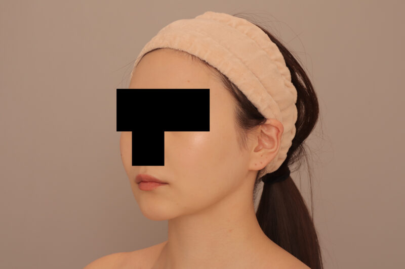 頬顎脂肪吸引で女優さんのような輪郭に♪