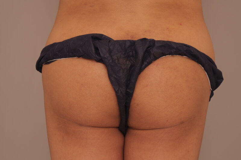 49歳ブラジリアンバットリフトのモニター様1ヶ月後