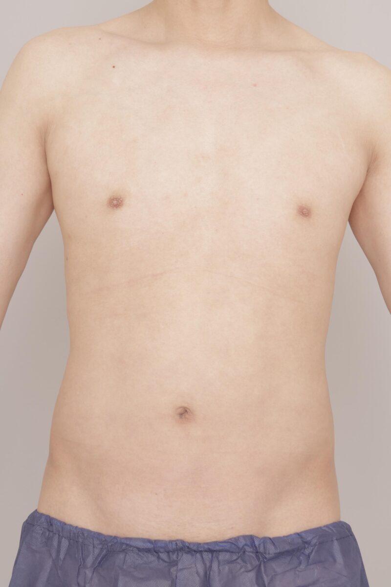 【男性】腹部全体＋胸下, 腰部 １か月経過～44歳, 186cm, 75kg～