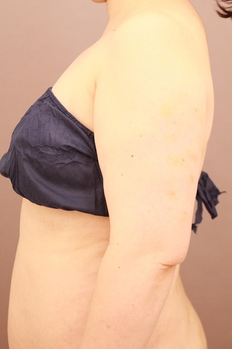 二の腕の脂肪吸引 1か月経過