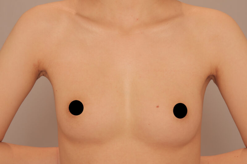 昨日のモニター様のコンデンスリッチ豊胸3か月後♡