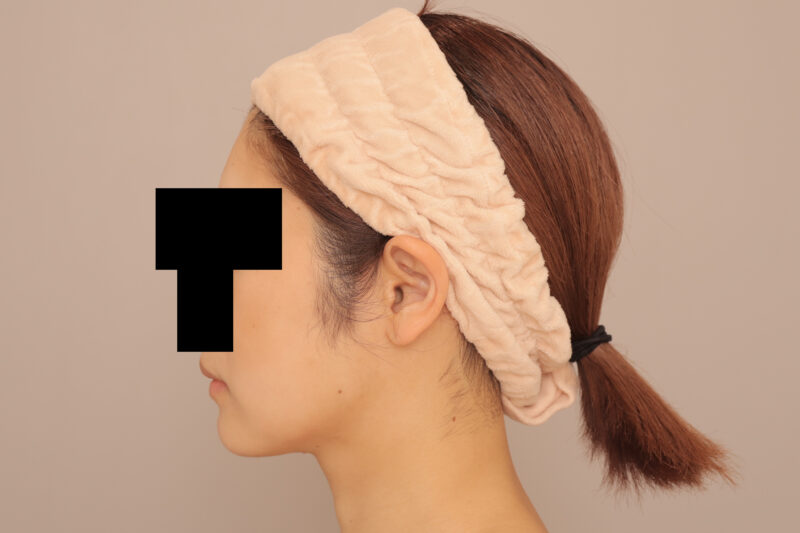 頬顎脂肪吸引でスッキリ小顔♪より美しいフェイスラインに!半年後