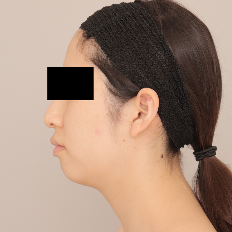 フェイスライン彫刻　26歳　頬＋顎下、顎ヒアルロン酸、ボトックス（顎・エラ）