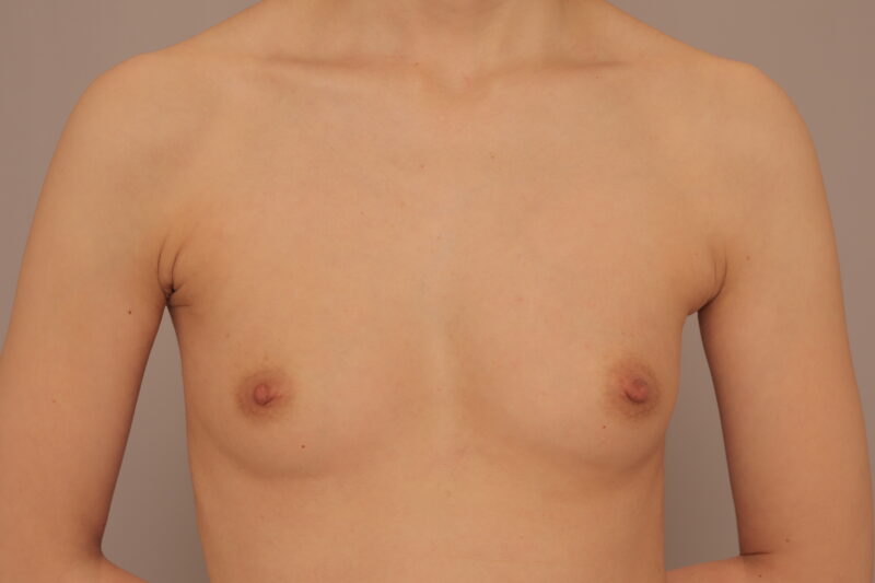 昨日のモニター様のバストの変化3か月後♪バストも別人に♡