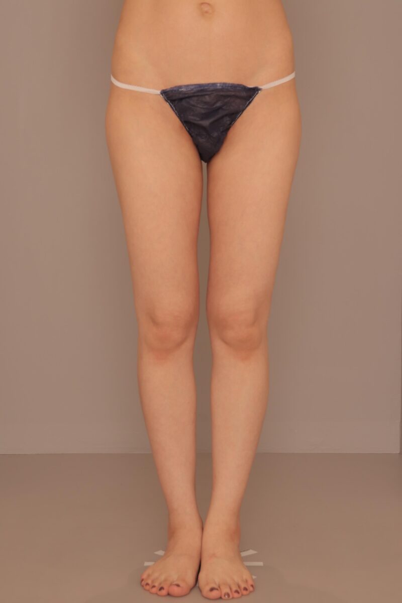 豊胸ついでに太ももを韓国アイドルのようなスラッと細い脚に♪太ももの脂肪吸引3か月後