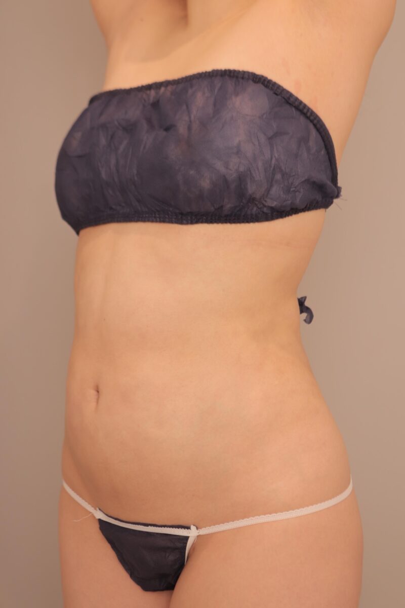 お腹全体胸下腰の脂肪吸引3か月後♡