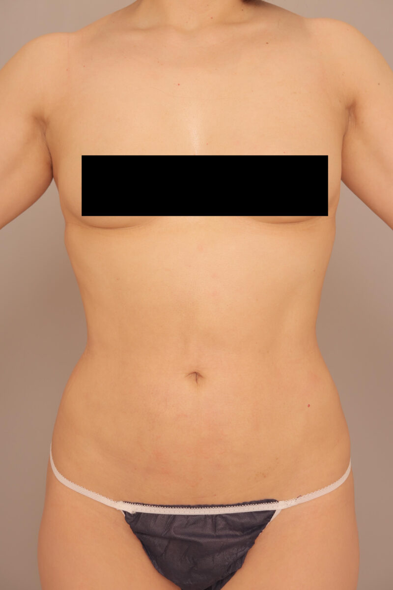 「コートが入るようになった!!!」48歳のモニター様の脇肉吸引の変化♡3ヶ月後