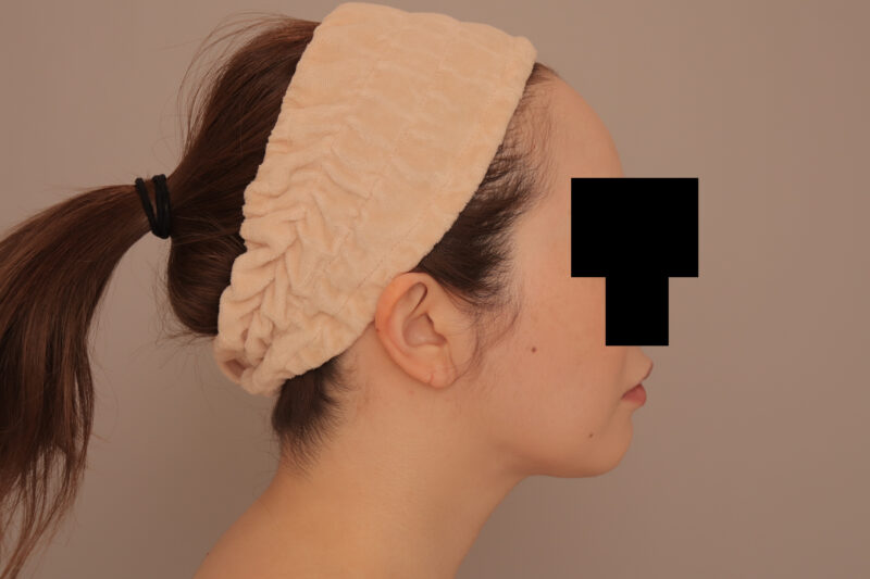 頬顎脂肪吸引でまっすます美人さんに♡モニター様半年後