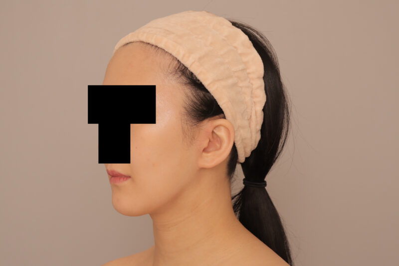 頬顎脂肪吸引でまっすます美人さんに♡