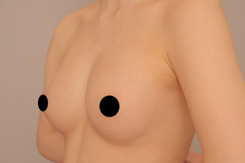 コンデンスリッチ豊胸でバストの形を変える!!21歳授乳経験無しのモニター様3か月後