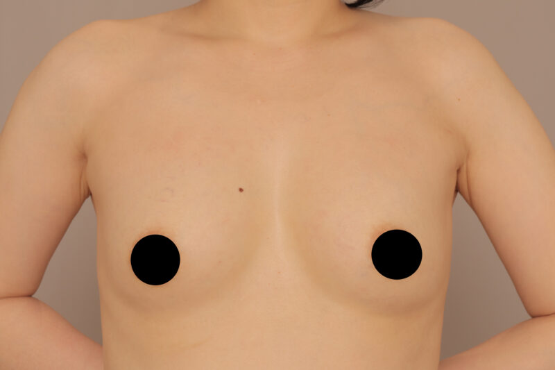 シリコンバッグを抜去し脂肪注入で自然なバストに♡モニター様半年後